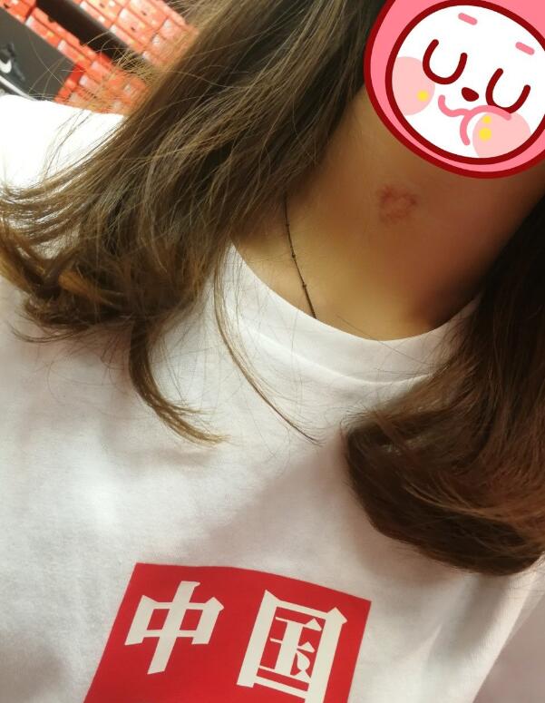 草莓印怎么快速消除掉 草莓印用什么可以遮挡