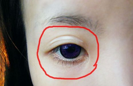 死鱼眼是怎么形成的 死鱼眼有什么办法恢复吗