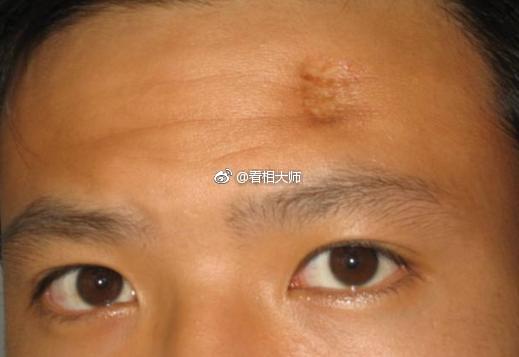 ��ͷ�а̺۵����� ���ܻ���һ��ʱ�����˲���