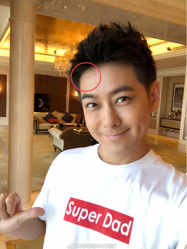 ��ͷ�а̺۵����� ���ܻ���һ��ʱ�����˲���