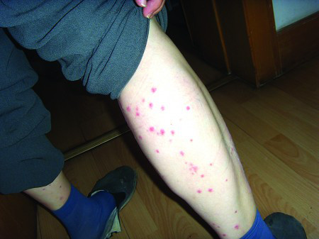 虼蚤咬过的图片 被跳蚤咬了怎么办