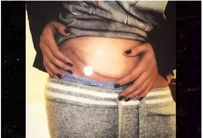 赛琳娜为什么叫傻脸妹 赛琳娜戈麦斯换肾后能活多久