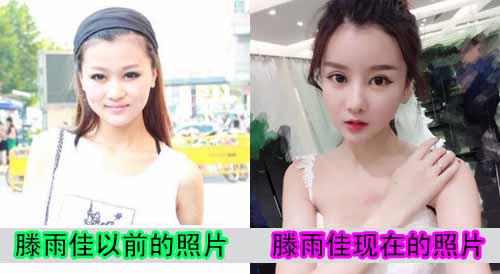滕雨佳整容前后对比照片 她直播的时候关美颜差点吓死网友