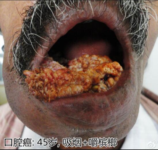 槟榔吃多了口腔癌图片图片