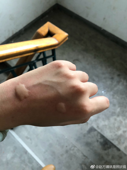 白纹伊蚊咬的包图片 伊蚊在中国的分布情况是怎样的