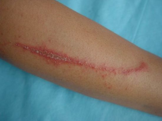 �����ҧ�˺�ͼƬ ����涣ҧ��֢״ͼ