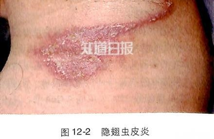 �����ҧ�˺�ͼƬ ����涣ҧ��֢״ͼ