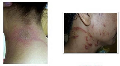 �����ҧ�˺�ͼƬ ����涣ҧ��֢״ͼ