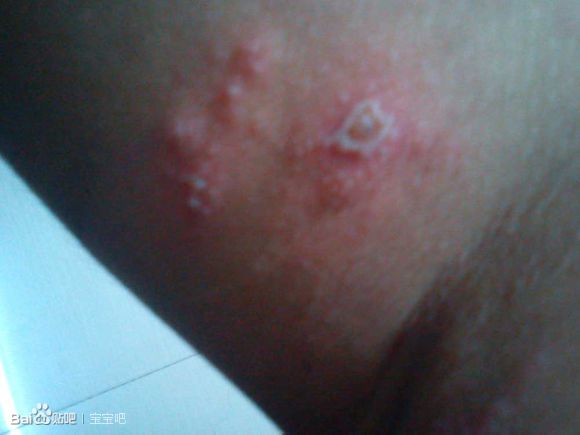 �����ҧ�˺�ͼƬ ����涣ҧ��֢״ͼ