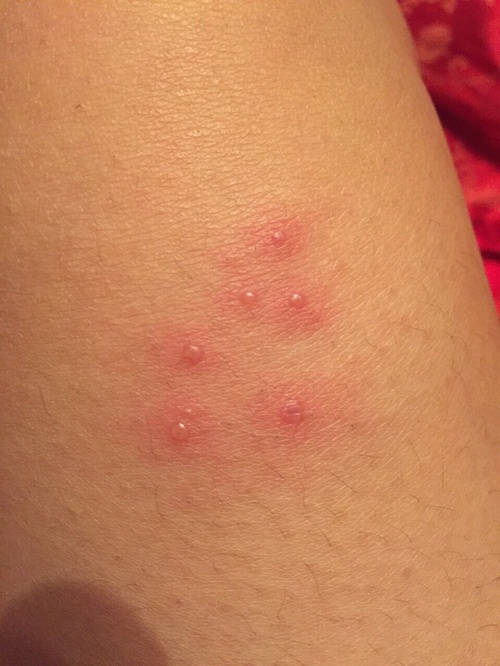 �����ҧ�˺�ͼƬ ����涣ҧ��֢״ͼ