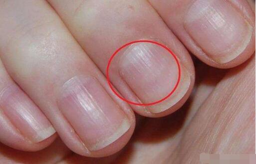 ָ�����а�ɫ�ߵ�����ô���� ָ���϶���������ʲôԭ��