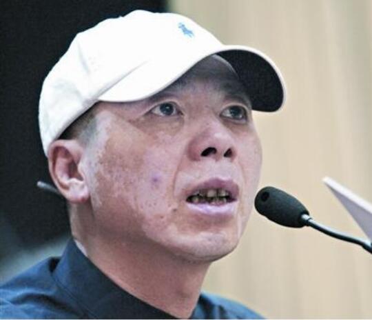 冯小刚白斑病自愈了真的吗 他白斑病最新的照片曝光