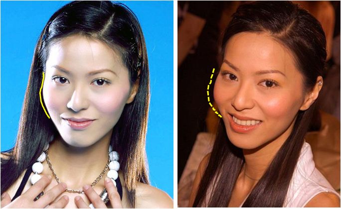 颧骨高和宽是克夫相的象征,因此才会有很多人选择磨骨改变脸型