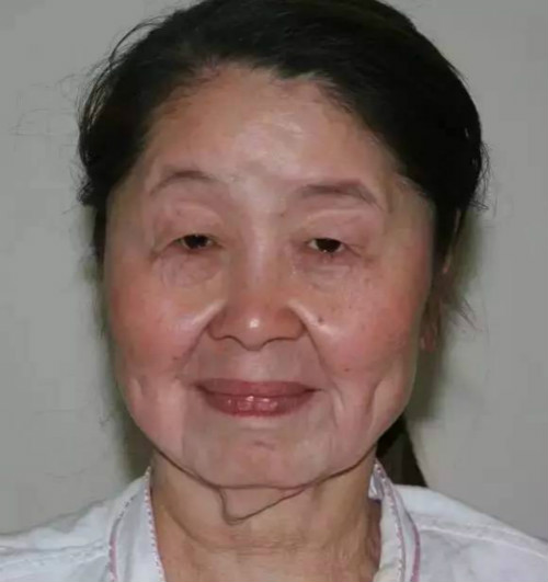 妙龄女一夜变老如80岁老太 年轻少妇分娩之后满面皱纹令人震惊