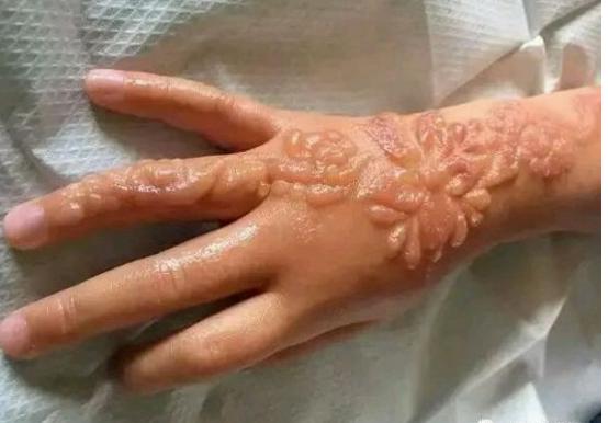 海娜纹身怎么洗掉 海娜纹身的危害有哪些