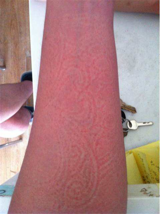 ����Ѫ�����Ⱦ�ǰ����ô���������� ����Ѫ��������ס����ʵ����