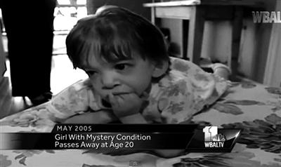 不老症的人能活多少岁 患有不老症的人真的会长生不老吗