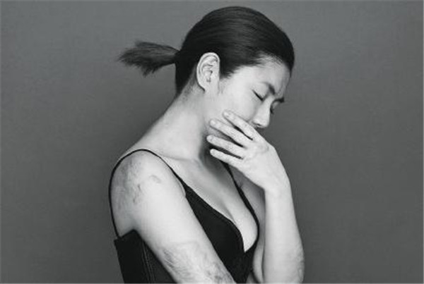 selina现在的照片最新消息 任家萱烧伤前后对比疤痕吓人植皮了吗