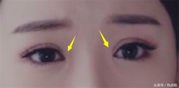 毛晓彤整容前后对比照片曝光 毛晓彤是不是开眼角了疤痕好明显