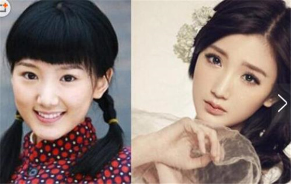 毛晓彤整容前后对比照片曝光 毛晓彤是不是开眼角了疤痕好明显