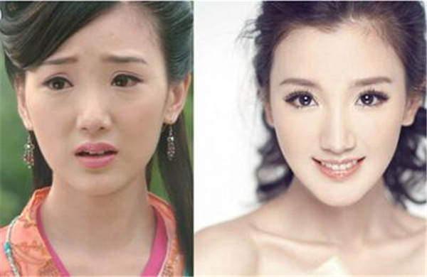 毛晓彤整容前后对比照片曝光 毛晓彤是不是开眼角了疤痕好明显