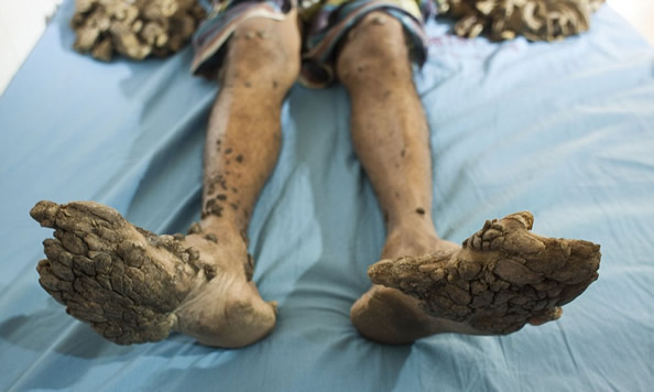 现实中真的有"树人"存在 世界上最全的树人症图片切掉后会复发