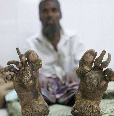 现实中真的有"树人"存在 世界上最全的树人症图片切掉后会复发