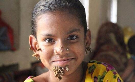 现实中真的有"树人"存在 世界上最全的树人症图片切掉后会复发