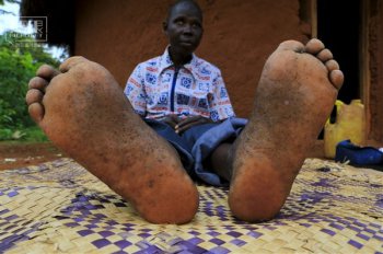 非洲小孩的沙蚤脚 恐怖的沙蚤病是怎么造成的