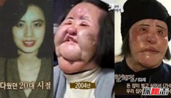 韩国电风扇大妈 手术的失败而痛苦地度过了余生