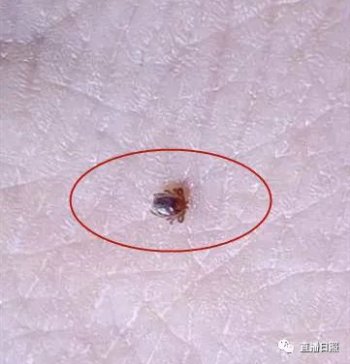 扁虱是什么 是甲壳类节肢动物