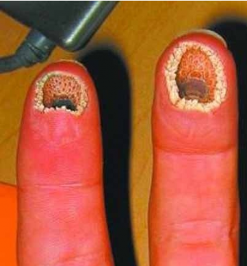 空手指因为什么引起 空手指为什么吓人