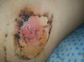 火疖子怎么才算挤干净