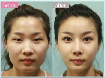 ����Ϫ˫��Ƥ�Ǹ���� ��˫��Ƥ����ͦ��Ȼ��