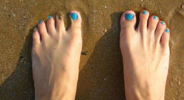 罗马脚女人命运 罗马脚适合穿什么鞋子