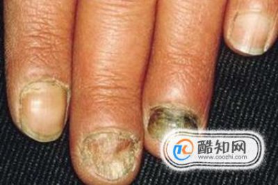 灰指甲的症状图片 灰指甲刚开始的图片