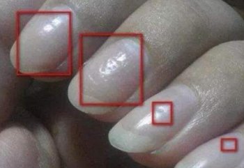 指甲上有横纹凹陷图片 你指甲上的水平条纹是怎么回事