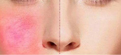 黄褐斑与晒斑最直观区别图片 形成原因不同症状不同