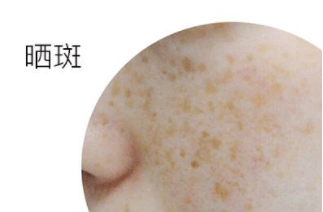 黄褐斑与晒斑最直观区别图片 形成原因不同症状不同