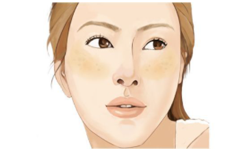 黄褐斑与晒斑最直观区别图片 形成原因不同症状不同