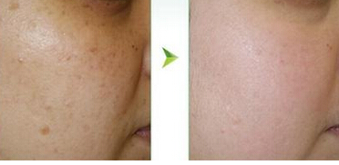 黄褐斑与晒斑最直观区别图片 形成原因不同症状不同