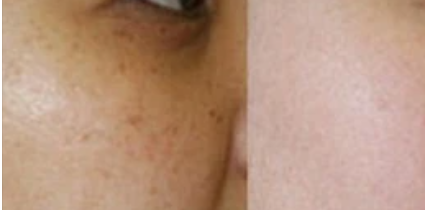 黄褐斑与晒斑最直观区别图片 形成原因不同症状不同