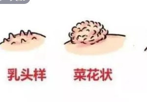 ����ʪ��ͼ֢״Ů �����ļ����Ƿǳ����