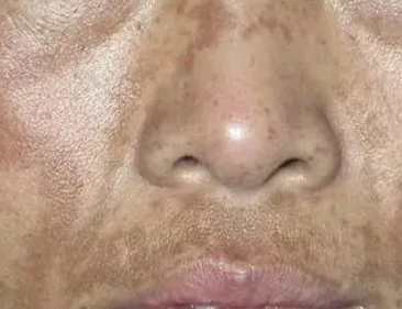 ��Ȼƺְ�ͼƬ һ�㲡�̲�����ȷ��