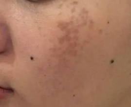 ��Ȼƺְ�ͼƬ һ�㲡�̲�����ȷ��