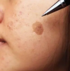 ��Ȼƺְ�ͼƬ һ�㲡�̲�����ȷ��