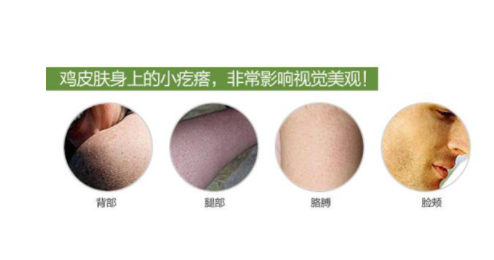 鸡皮肤怎么消除 使用滋润型的身体乳