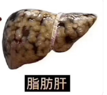 脂肪肝怎么调理好 改变不良的饮食习惯