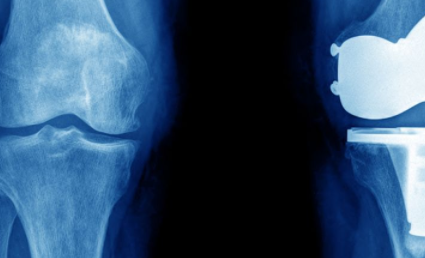 ���°��г�����ʲôӰ�� ϥ�ؽڰ��°�������ô����