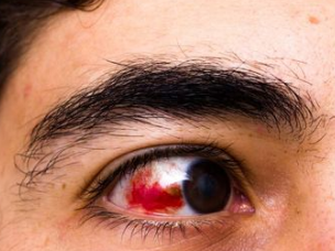 �۾���Ѫ��ԭ��ͼƬ �۾���Ѫ��ô��